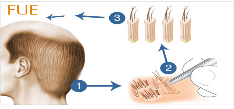 fue-hair-transplant-success-rate-img