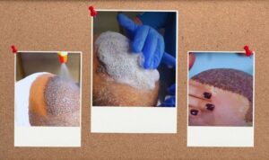 Post-transplant-Hair-Care-Tips