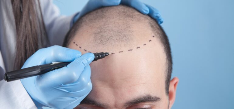 Hair Transplant in Manchester: Permanent Treatment to Baldness