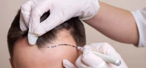 efficiency-of-hair-transplant-clinic-in-briminghum-img