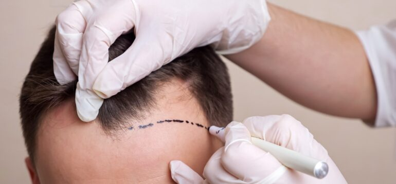 efficiency-of-hair-transplant-clinic-in-briminghum-img