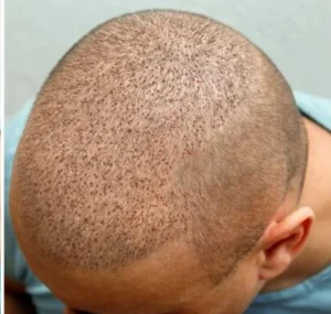 Take-Care-of-Scalp-After-Hair-Transplant