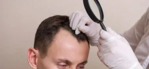 causes-and-hair-loss-treatment-manchester-img
