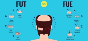 dhi-vs-fue-hair-transplant-procedures-which-is-best-img