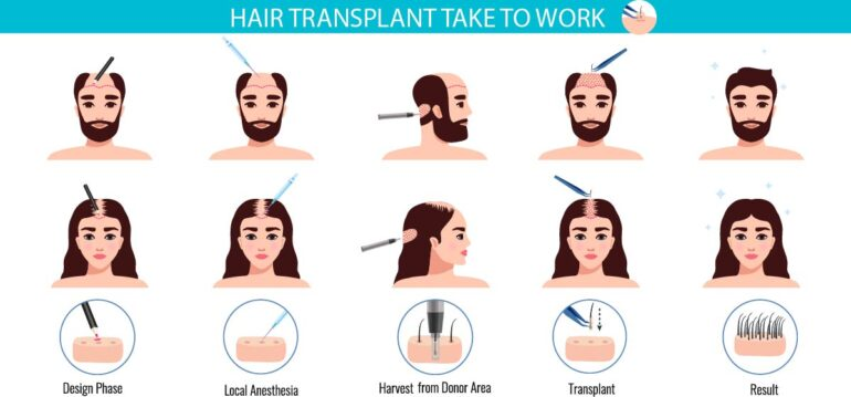 how-long-does-a-hair-transplant-take-to-work-img