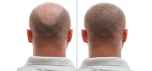 how-many-hair-transplants-can-you-have-img