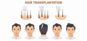 how-much-is-a-hair-transplant-uk-img