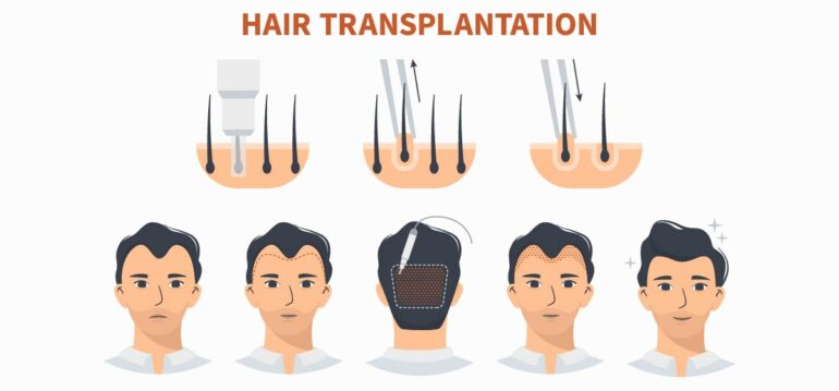 how-much-is-a-hair-transplant-uk-img