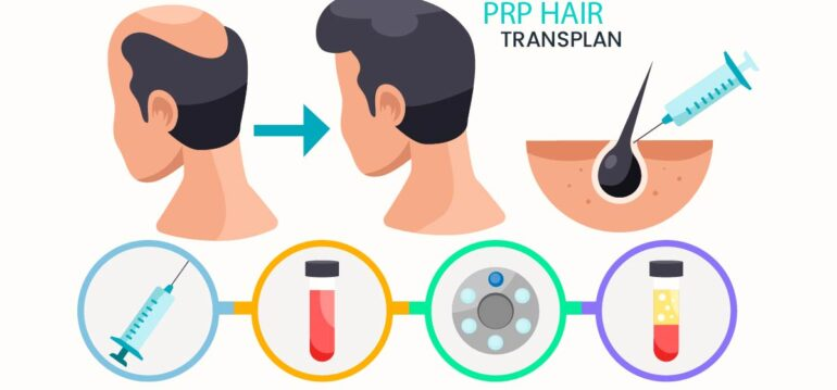 PRP VS Hair Transplant