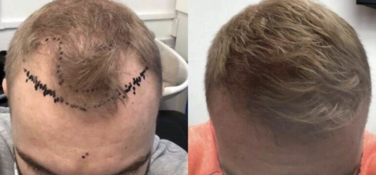 strip-or-fue-hair-transplant-surgery-in-briminghum-img