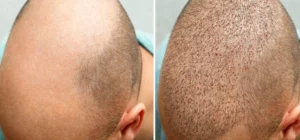 dhi-hair-transplant-before-and-after