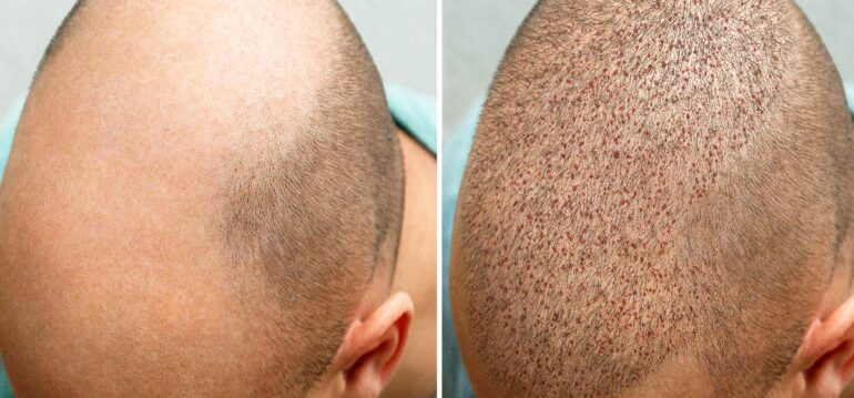 dhi-hair-transplant-before-and-after