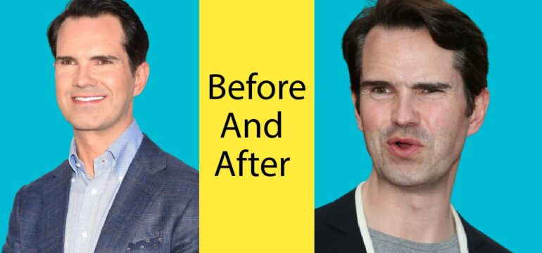 jimmy-carr-before-and-after-transplant-img