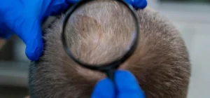 the-best-hair-transplant-without-shaving-uk-img