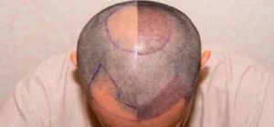 how-many-hair-grafts-do-i-need-img