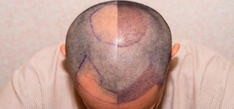 how-many-hair-grafts-do-i-need-img