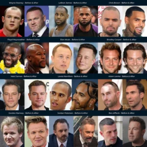 do-hair-transplant-looks-natural-img