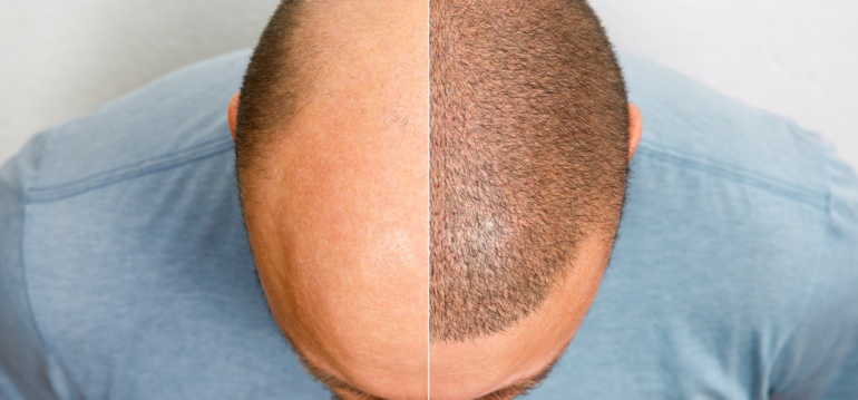 how-long-does-a-hair-transplant-last-and-is-it-img