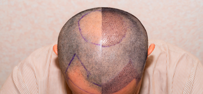 How painful is a Hair Transplant?
