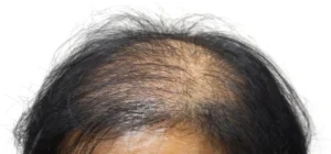 how-to-care-for-thinning-hair-img