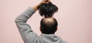 what-are-the-disadvantages-of-a-hair-transplant-img