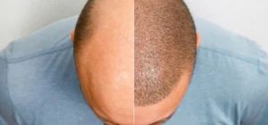 what-will-i-look-after-a-hair-transplant-img