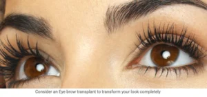 grow-back-your-eyebrows-with-Eyebrow Surgery-img