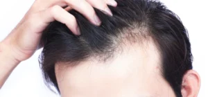 the-best-age-of-hair-transplant-when-should-you-have-one-img