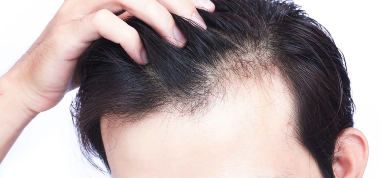the-best-age-of-hair-transplant-when-should-you-have-one-img