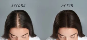 what-to-expect-during-a-female-hair-transplant-img