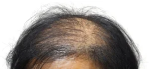 discover-the-different-types-of-hair-transplants-for-women-img
