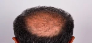 the-importance-of-hair-donor-area-in-male-img