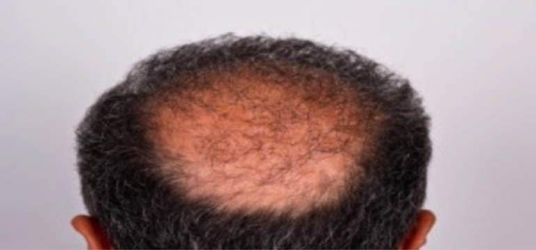 The Importance of the Hair Donor Area in Male Hair Transplantation