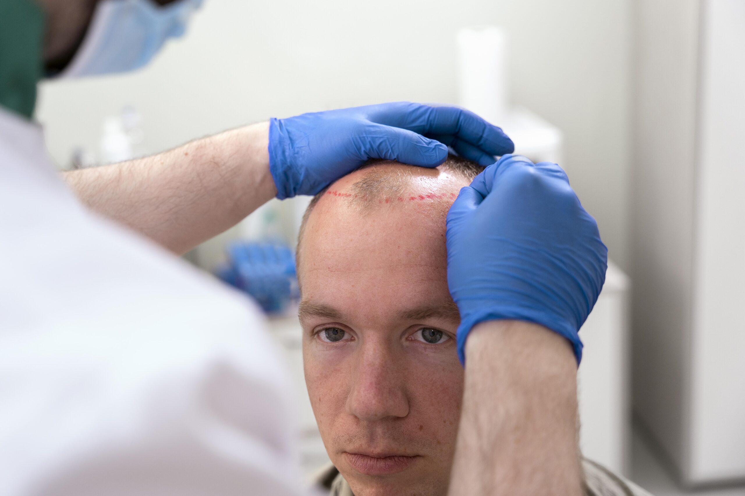 What is the Difference Between Surgical and Non-Surgical Hair Transplant?