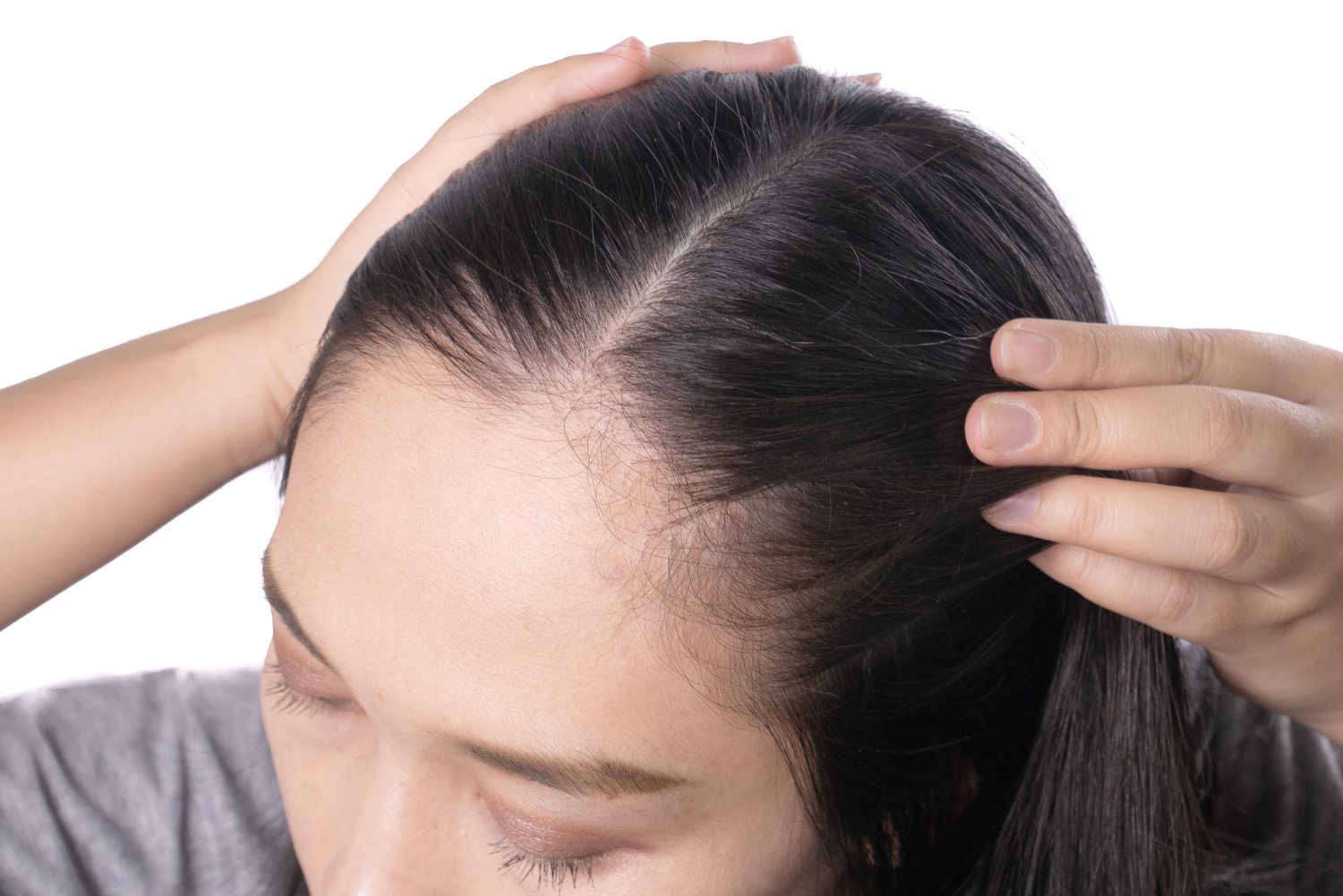 female-hair-transplant-1-img