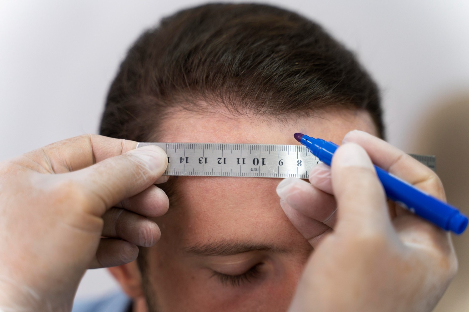 hair-transplant-1-img