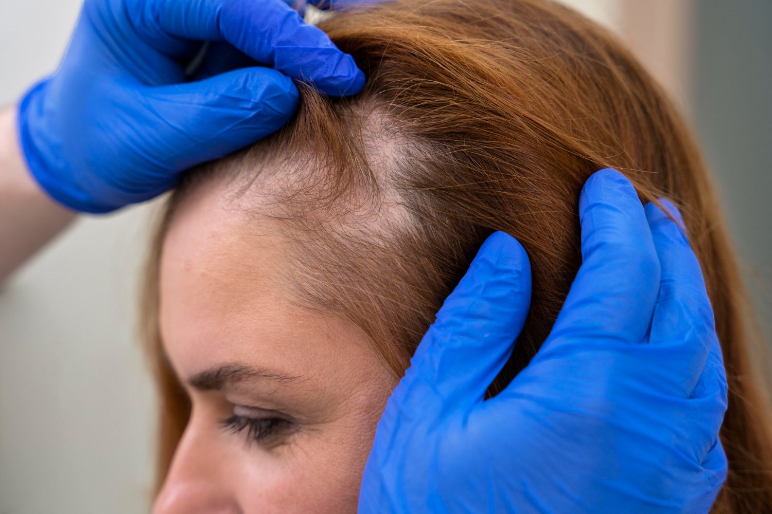 hair-transplant-4-img