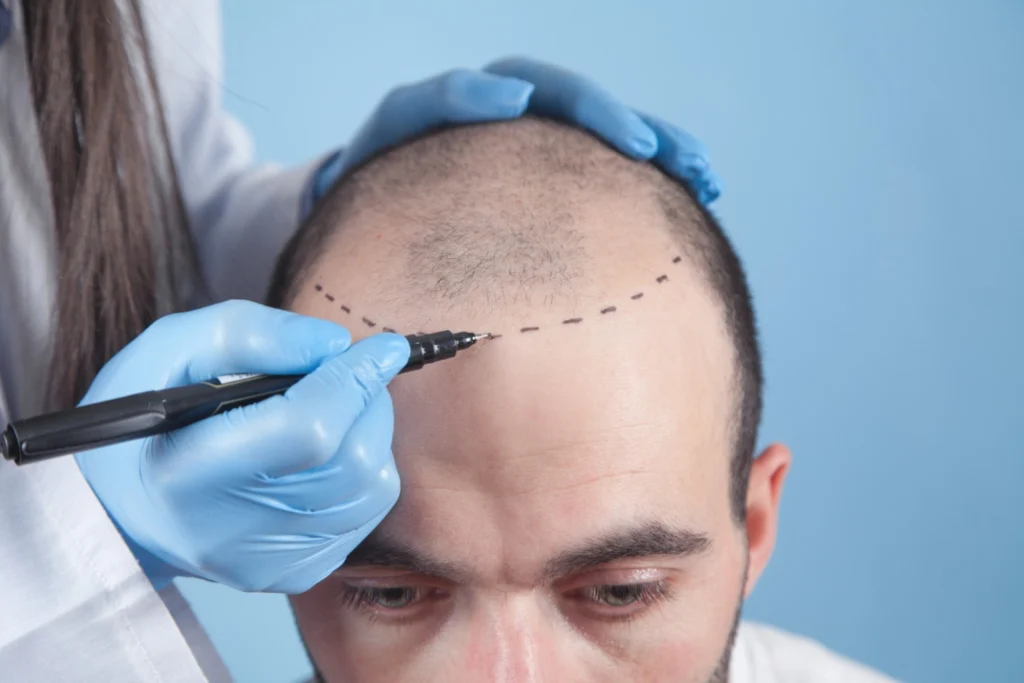 Difference-Between-FUT-and-FUE-Hair-Restoration-Techniques?