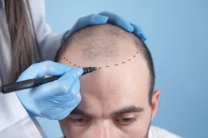 Difference-Between-FUT-and-FUE-Hair-Restoration-Techniques?