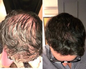 PRP-Sessions-Needed-After-hair-Transplant