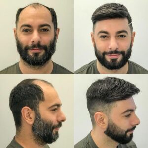 FUT and FUE combination hair transplant