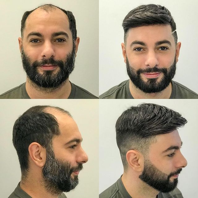 Why Do Some Patients Combine FUT and FUE for Better Results?