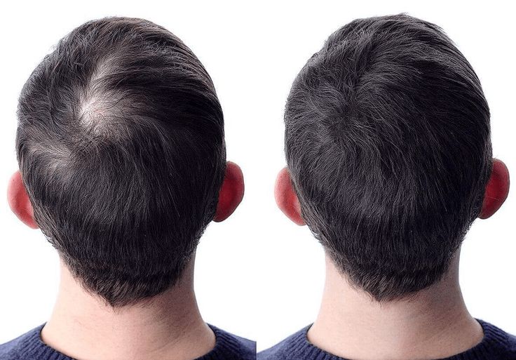 How Can I Increase the Density of My Transplanted Hair?