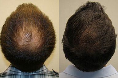 What-Structures-Need-to-Be-Transplanted-to-Ensure-That-New-Hairs-Will-Grow?