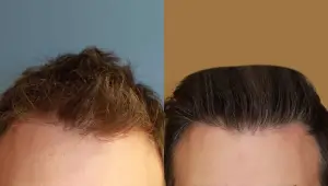 New-Hair-to-Grow-After-Hair-Transplant