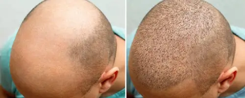 Recover from a Hair Transplant