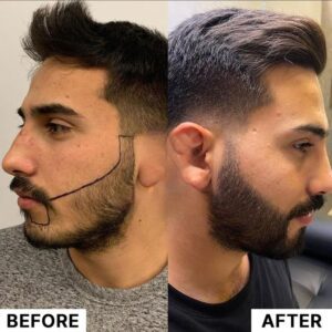 Before and after beard Transplant