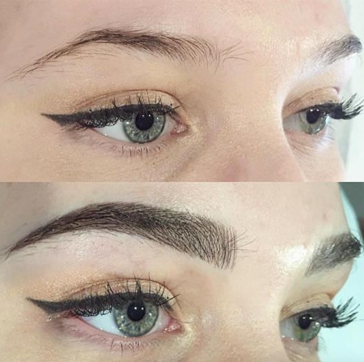 Eyebrow Looks after Transplant