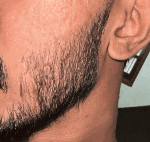 Cobblestone-After-a-Beard-Transplant