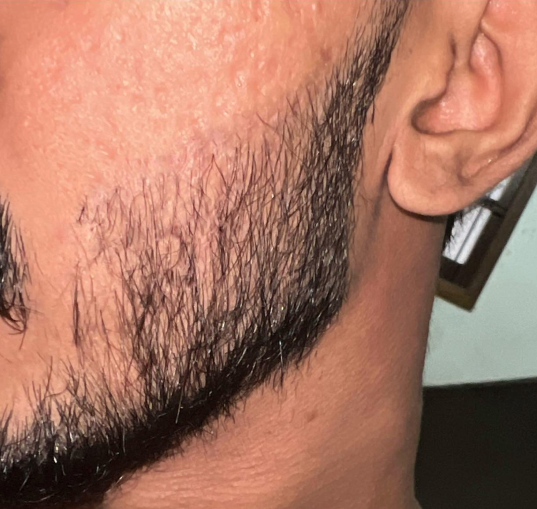 How Do You Get Rid of Cobblestone After a Beard Transplant?